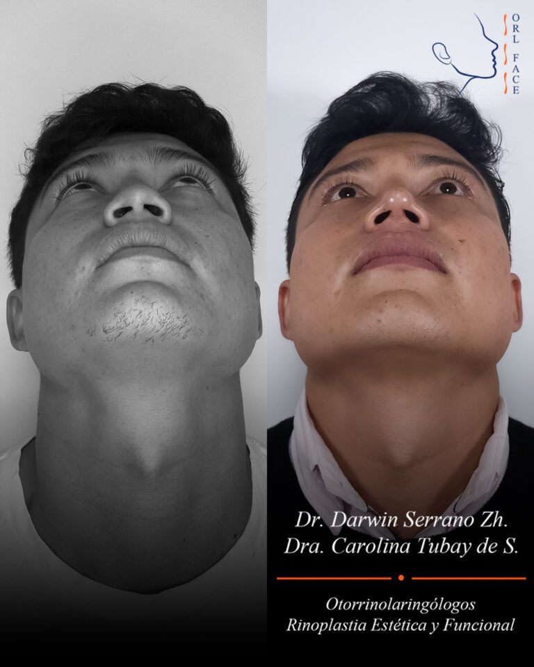 Dr. Darwin Serrano Zh. Dra. Carolina Tubay. Otorrinolaringologo, Otorrino. Salinas. Cirugia estetica nasal.