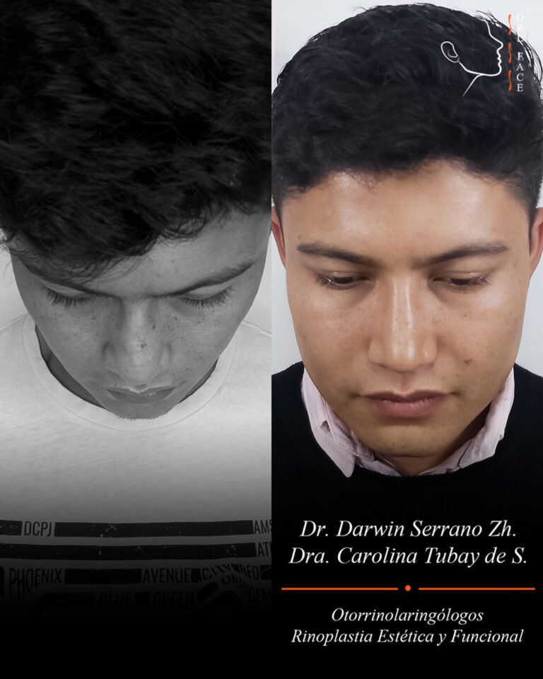 Dr. Darwin Serrano Zh. Dra. Carolina Tubay. Otorrinolaringologo, Otorrino. Salinas. Cirugia estetica nasal.