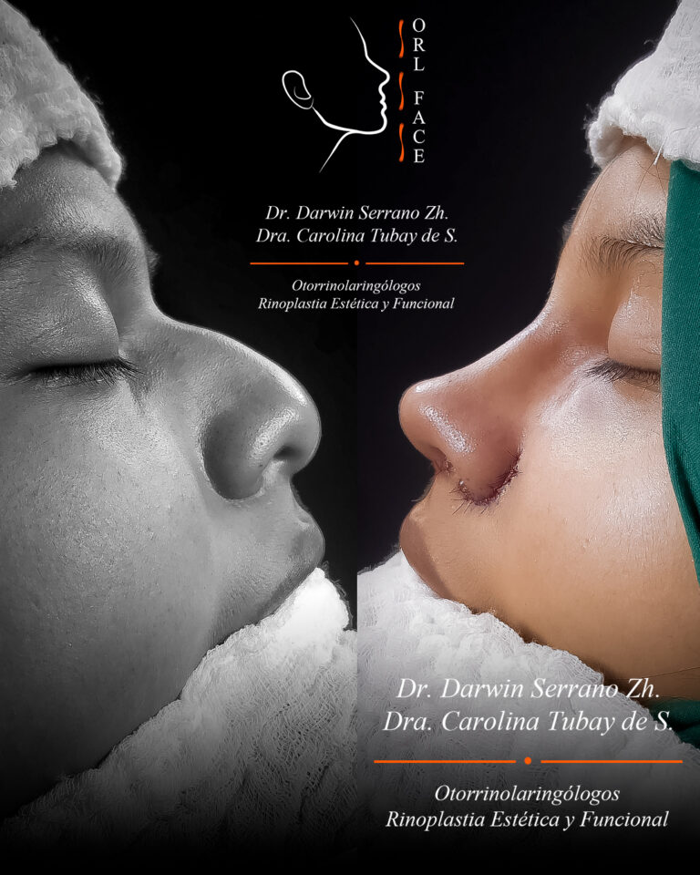 Dr. Darwin Serrano Zh. Dra. Carolina Tubay. Otorrinolaringologo, Otorrino. Salinas. Cirugia estetica nasal.