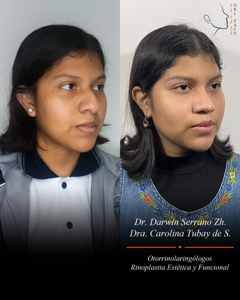 Dr. Darwin Serrano Zh. Dra. Carolina Tubay. Otorrinolaringologo, Otorrino. Salinas. Cirugia estetica nasal.