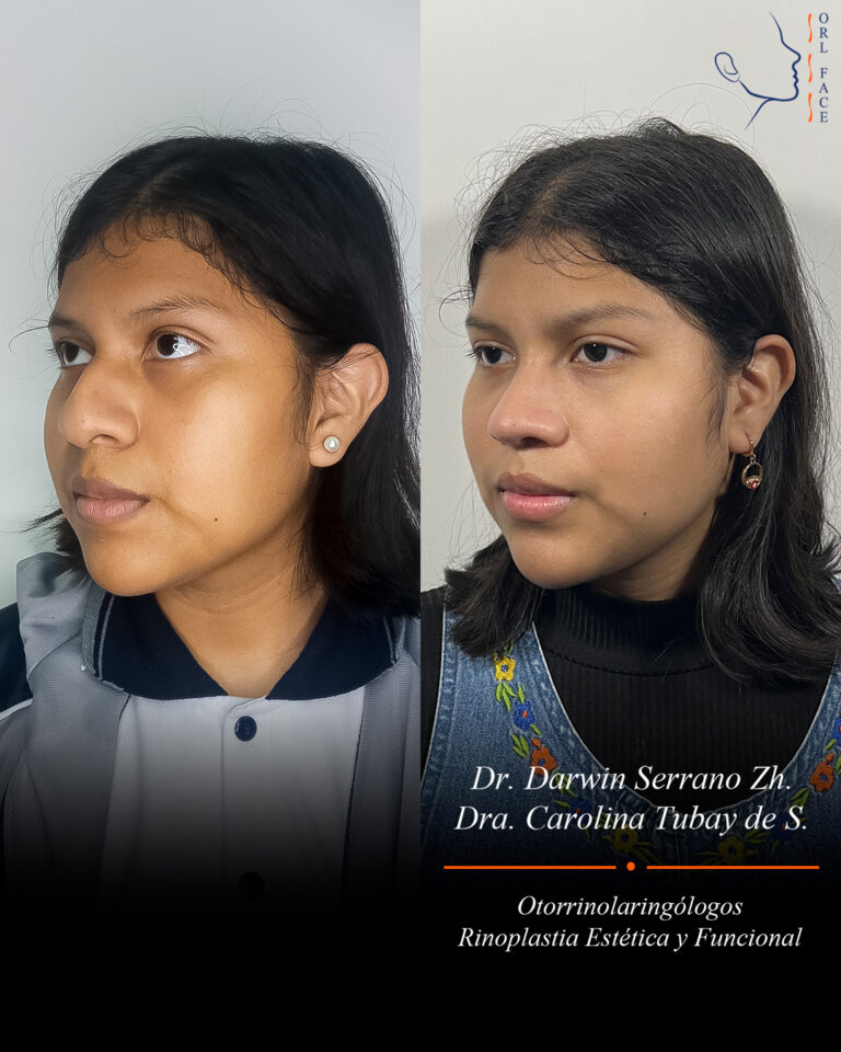 Dr. Darwin Serrano Zh. Dra. Carolina Tubay. Otorrinolaringologo, Otorrino. Salinas. Cirugia estetica nasal.