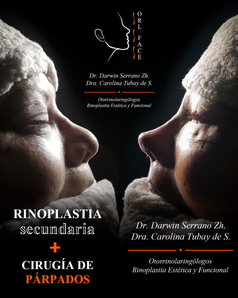 Dr. Darwin Serrano Zh. Dra. Carolina Tubay. Otorrinolaringologo, Otorrino. Salinas. Cirugia estetica nasal.