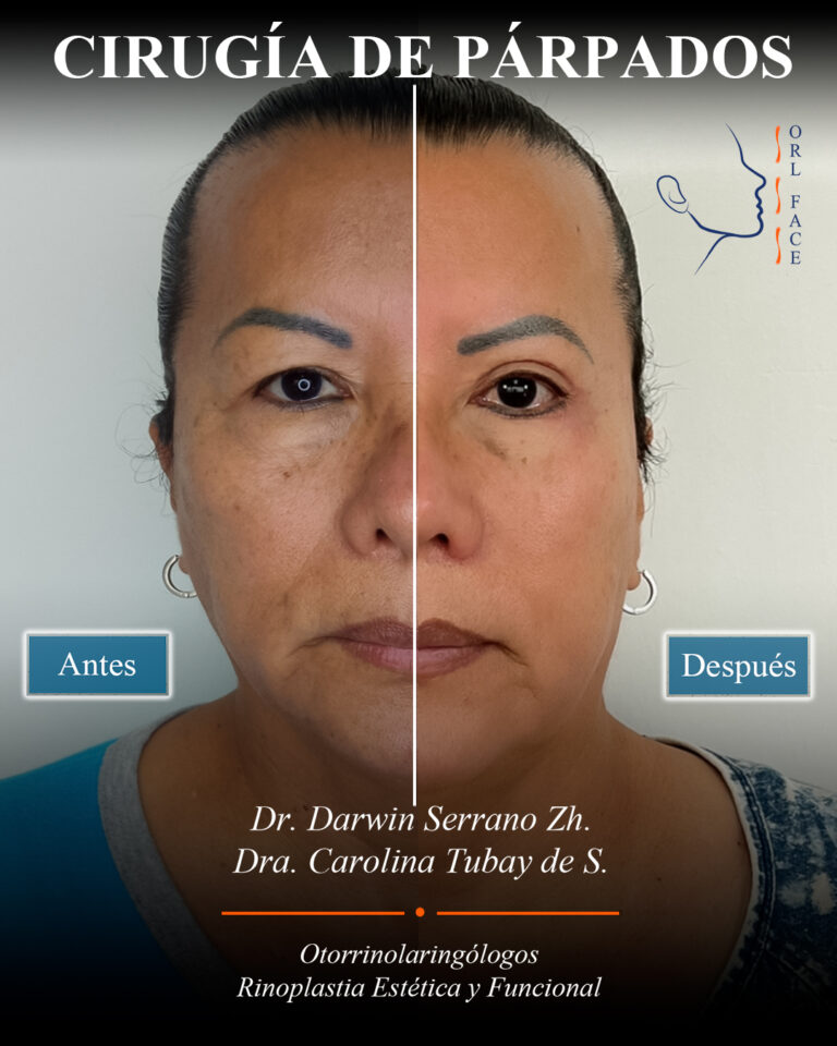 Dr. Darwin Serrano Zh. Dra. Carolina Tubay. Otorrinolaringologo, Otorrino. Salinas. Cirugia estetica nasal.