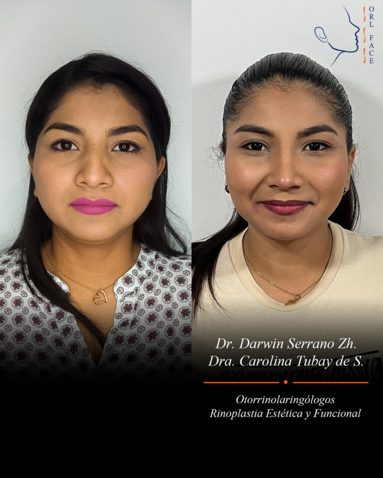 Dr. Darwin Serrano Zh. Dra. Carolina Tubay. Otorrinolaringologo, Otorrino. Salinas. Cirugia estetica nasal.