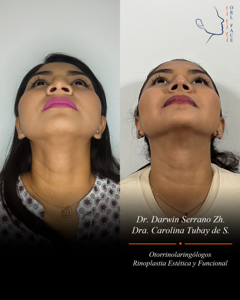 Dr. Darwin Serrano Zh. Dra. Carolina Tubay. Otorrinolaringologo, Otorrino. Salinas. Cirugia estetica nasal.