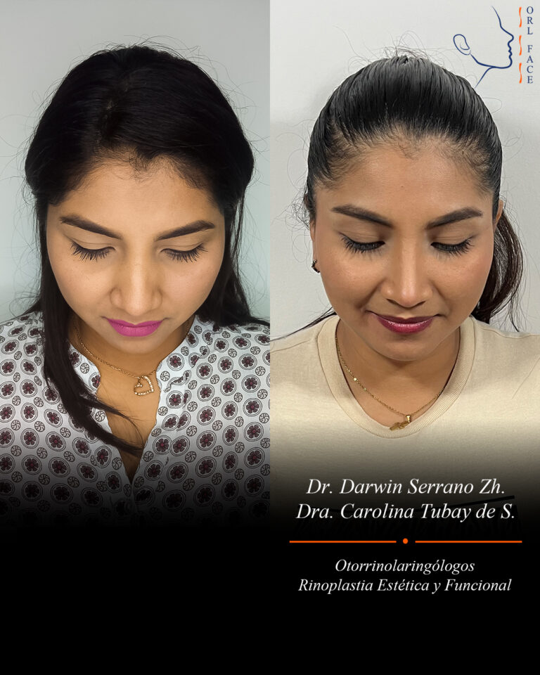 Dr. Darwin Serrano Zh. Dra. Carolina Tubay. Otorrinolaringologo, Otorrino. Salinas. Cirugia estetica nasal.