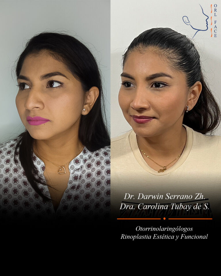 Dr. Darwin Serrano Zh. Dra. Carolina Tubay. Otorrinolaringologo, Otorrino. Salinas. Cirugia estetica nasal.