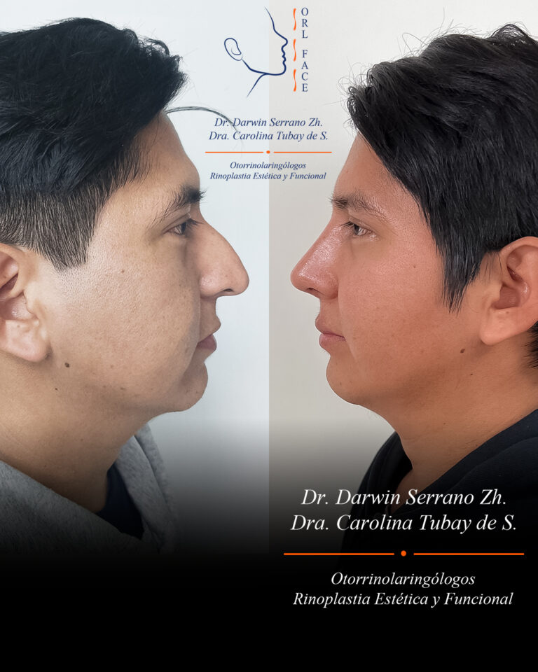 Dr. Darwin Serrano Zh. Dra. Carolina Tubay. Otorrinolaringologo, Otorrino. Salinas. Cirugia estetica nasal.