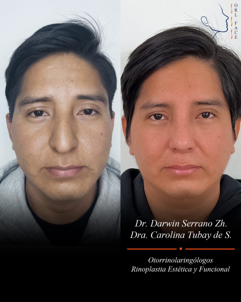 Dr. Darwin Serrano Zh. Dra. Carolina Tubay. Otorrinolaringologo, Otorrino. Salinas. Cirugia estetica nasal.
