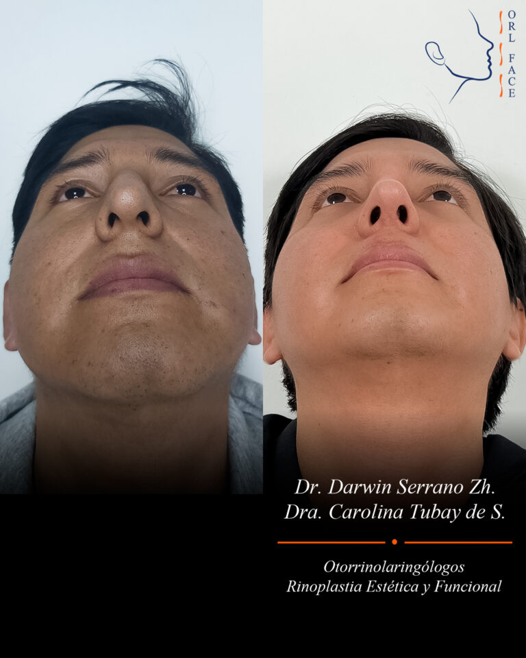 Dr. Darwin Serrano Zh. Dra. Carolina Tubay. Otorrinolaringologo, Otorrino. Salinas. Cirugia estetica nasal.