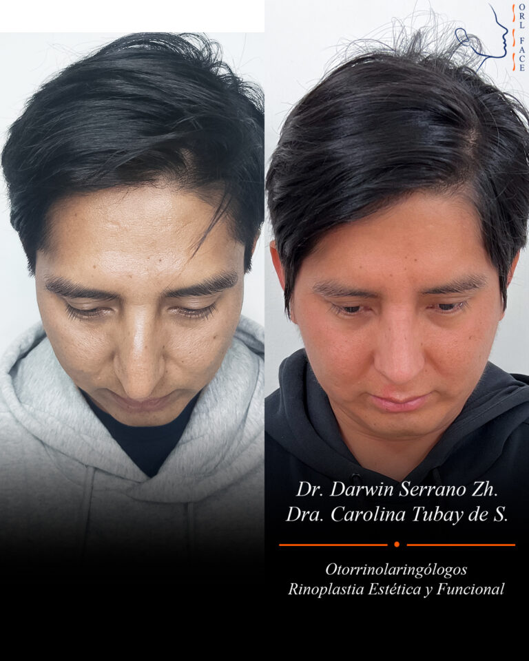 Dr. Darwin Serrano Zh. Dra. Carolina Tubay. Otorrinolaringologo, Otorrino. Salinas. Cirugia estetica nasal.