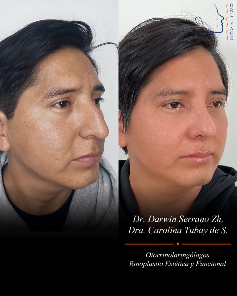 Dr. Darwin Serrano Zh. Dra. Carolina Tubay. Otorrinolaringologo, Otorrino. Salinas. Cirugia estetica nasal.