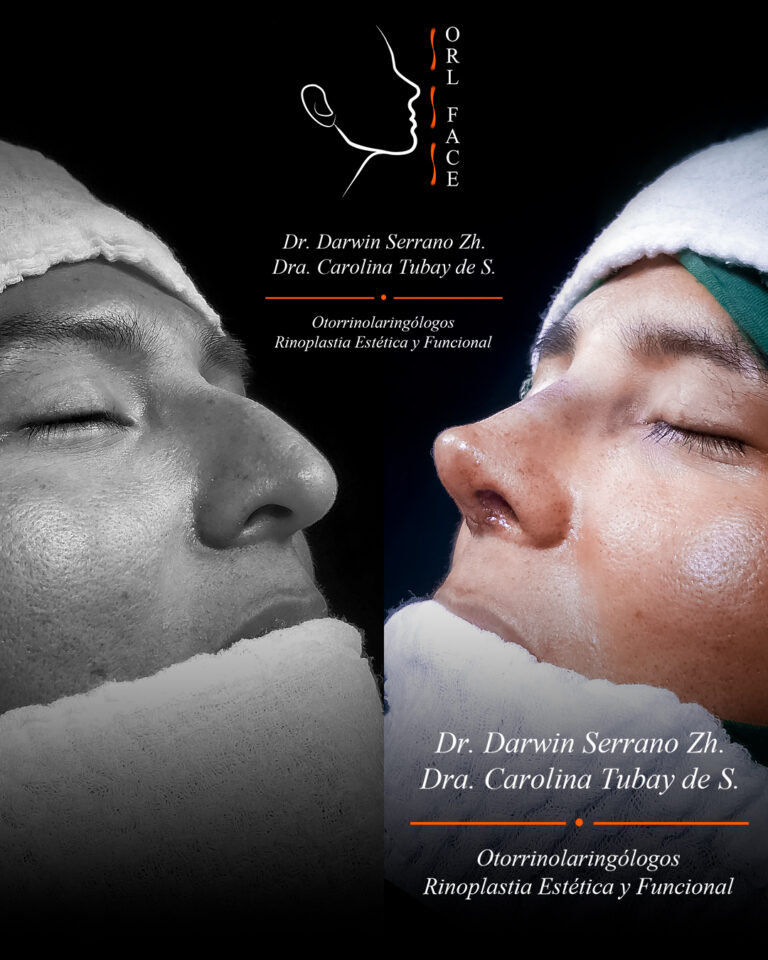 Dr. Darwin Serrano Zh. Dra. Carolina Tubay. Otorrinolaringologo, Otorrino. Salinas. Cirugia estetica nasal.