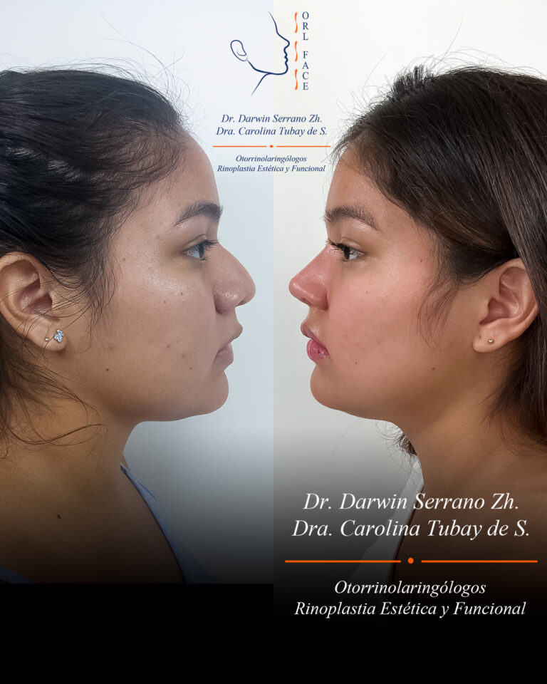 Dr. Darwin Serrano Zh. Dra. Carolina Tubay. Otorrinolaringologo, Otorrino. Salinas. Cirugia estetica nasal.