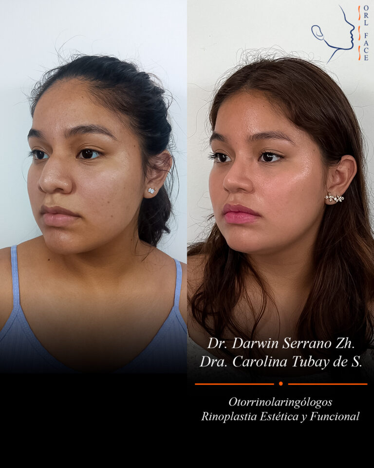 Dr. Darwin Serrano Zh. Dra. Carolina Tubay. Otorrinolaringologo, Otorrino. Salinas. Cirugia estetica nasal.