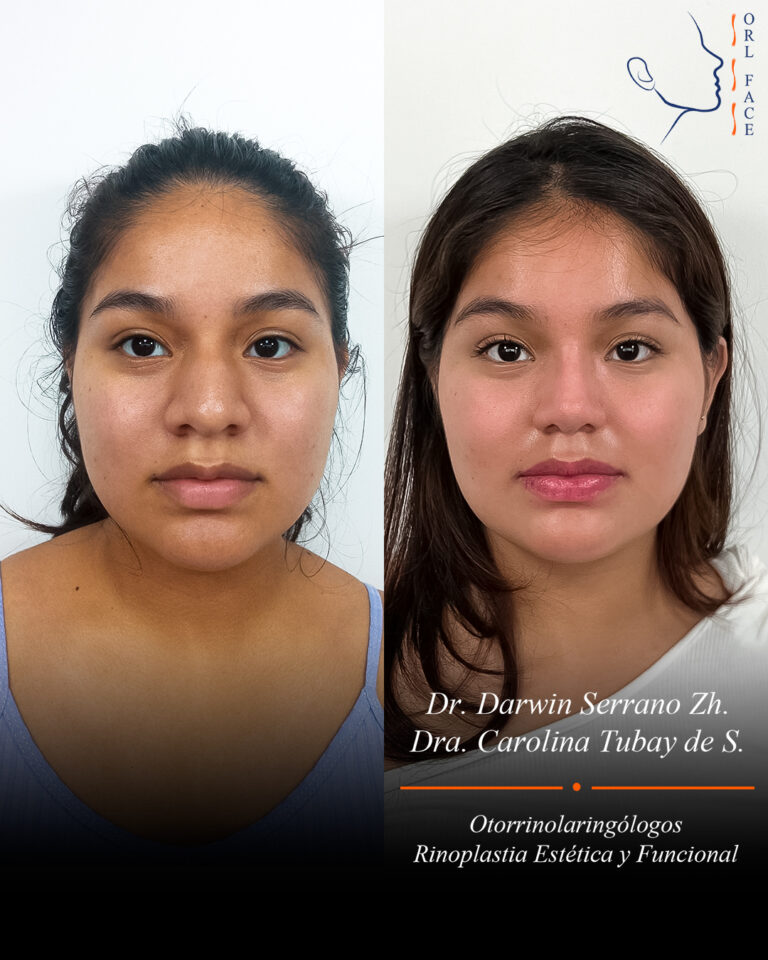 Dr. Darwin Serrano Zh. Dra. Carolina Tubay. Otorrinolaringologo, Otorrino. Salinas. Cirugia estetica nasal.