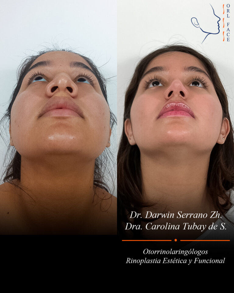 Dr. Darwin Serrano Zh. Dra. Carolina Tubay. Otorrinolaringologo, Otorrino. Salinas. Cirugia estetica nasal.