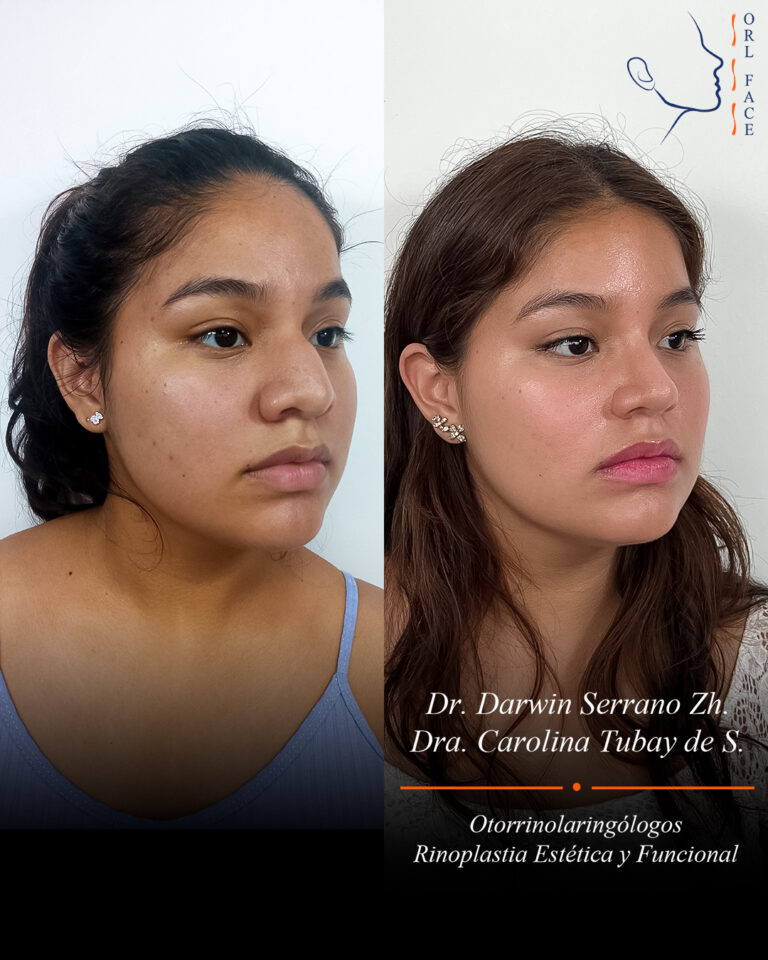 Dr. Darwin Serrano Zh. Dra. Carolina Tubay. Otorrinolaringologo, Otorrino. Salinas. Cirugia estetica nasal.