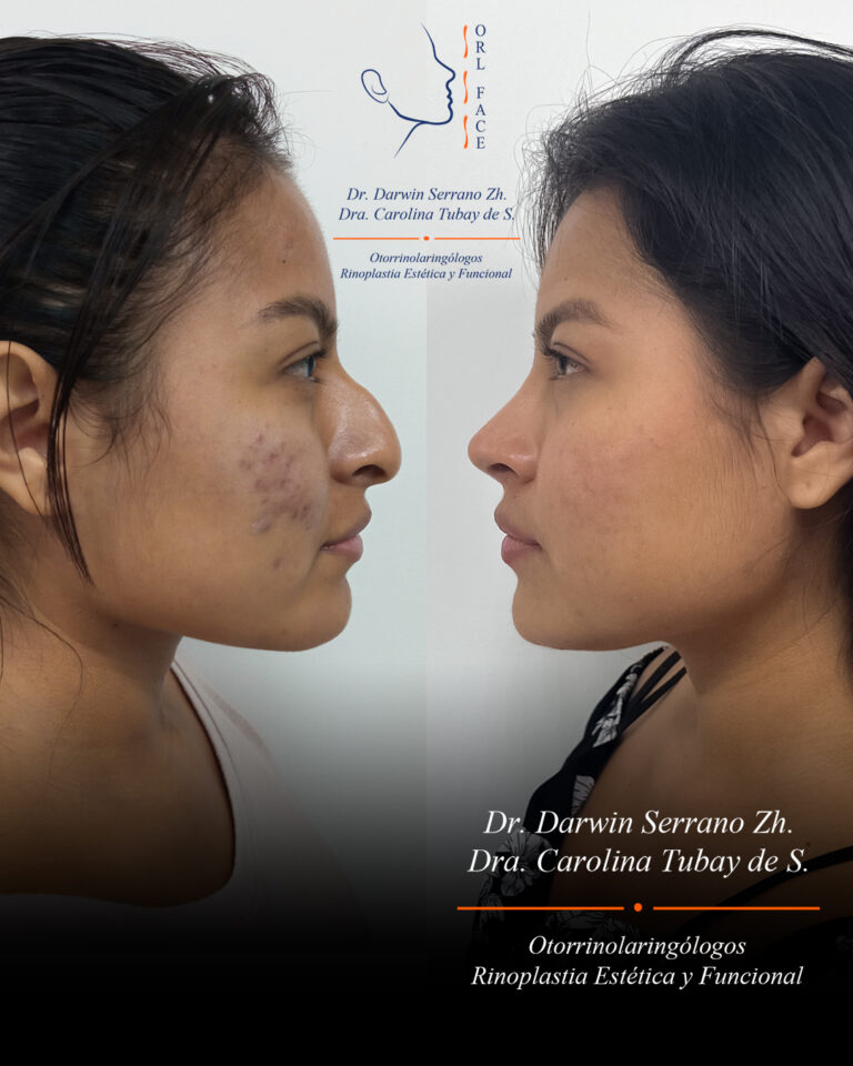 Dr. Darwin Serrano Zh. Dra. Carolina Tubay. Otorrinolaringologo, Otorrino. Salinas. Cirugia estetica nasal.