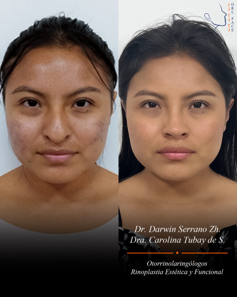 Dr. Darwin Serrano Zh. Dra. Carolina Tubay. Otorrinolaringologo, Otorrino. Salinas. Cirugia estetica nasal.
