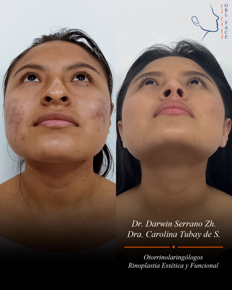 Dr. Darwin Serrano Zh. Dra. Carolina Tubay. Otorrinolaringologo, Otorrino. Salinas. Cirugia estetica nasal.