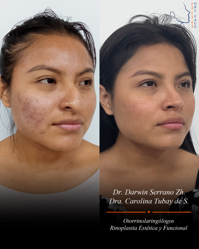 Dr. Darwin Serrano Zh. Dra. Carolina Tubay. Otorrinolaringologo, Otorrino. Salinas. Cirugia estetica nasal.