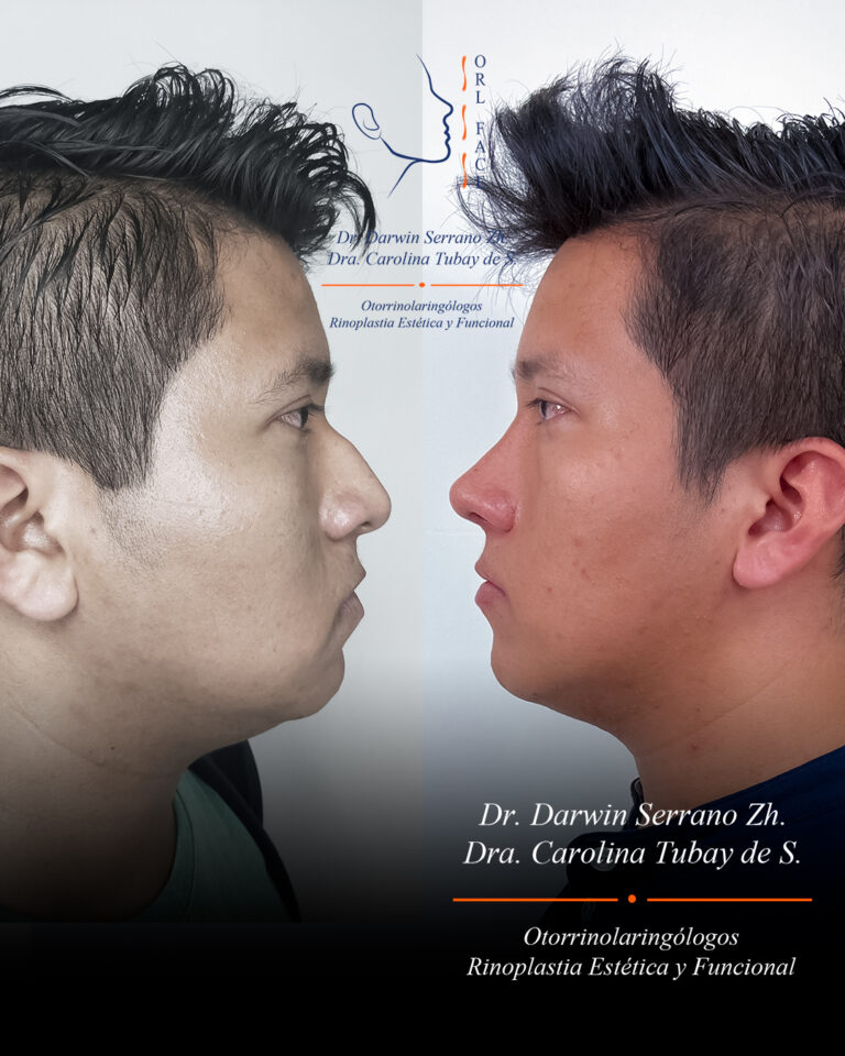 Dr. Darwin Serrano Zh. Dra. Carolina Tubay. Otorrinolaringologo, Otorrino. Salinas. Cirugia estetica nasal.