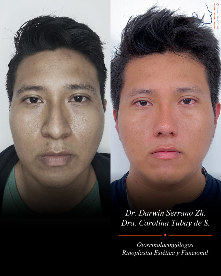 Dr. Darwin Serrano Zh. Dra. Carolina Tubay. Otorrinolaringologo, Otorrino. Salinas. Cirugia estetica nasal.