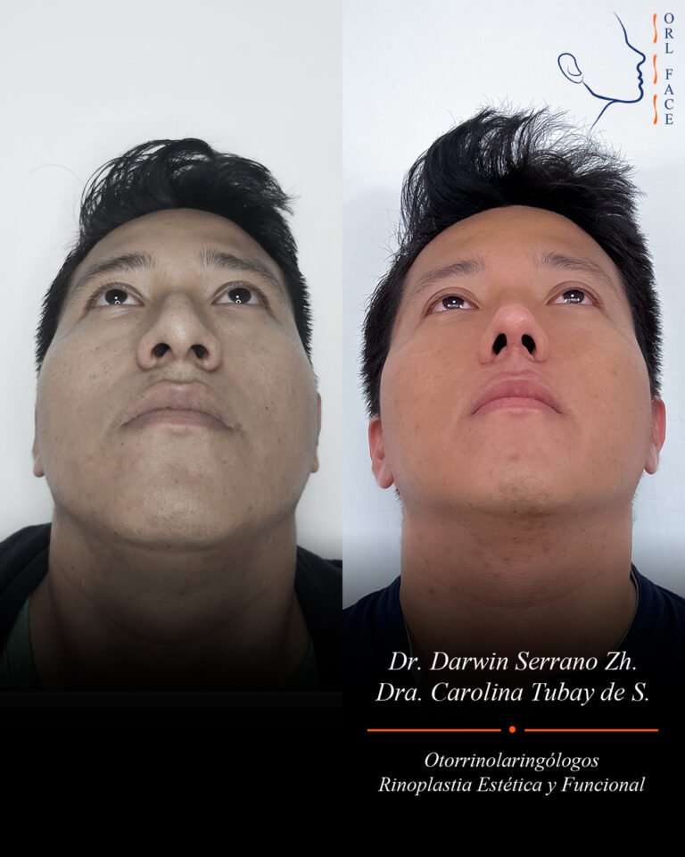 Dr. Darwin Serrano Zh. Dra. Carolina Tubay. Otorrinolaringologo, Otorrino. Salinas. Cirugia estetica nasal.