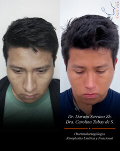 Dr. Darwin Serrano Zh. Dra. Carolina Tubay. Otorrinolaringologo, Otorrino. Salinas. Cirugia estetica nasal.