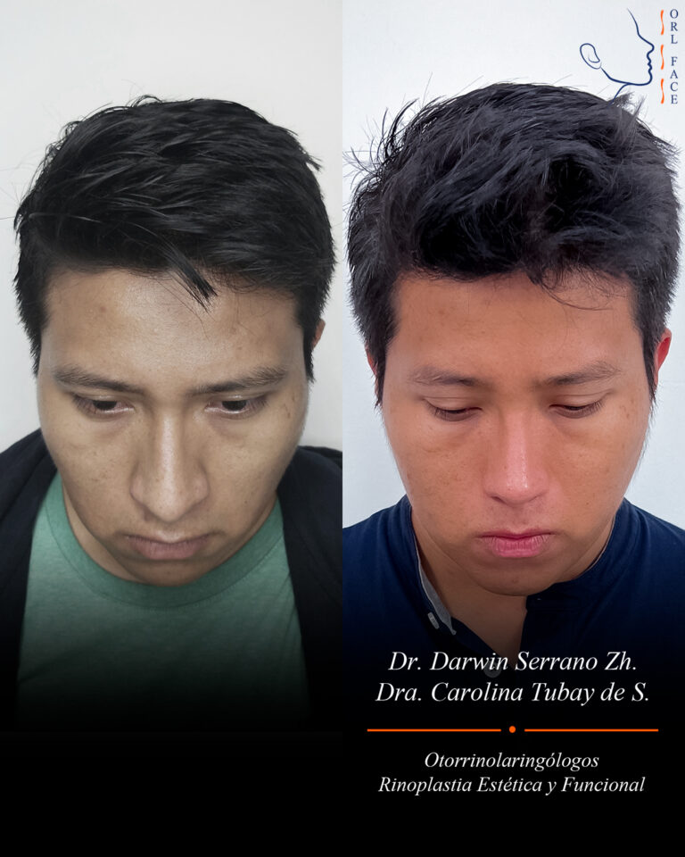Dr. Darwin Serrano Zh. Dra. Carolina Tubay. Otorrinolaringologo, Otorrino. Salinas. Cirugia estetica nasal.