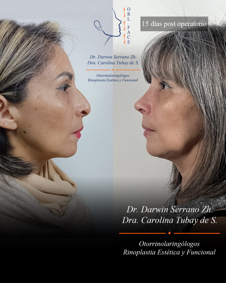 Dr. Darwin Serrano Zh. Dra. Carolina Tubay. Otorrinolaringologo, Otorrino. Salinas. Cirugia estetica nasal.