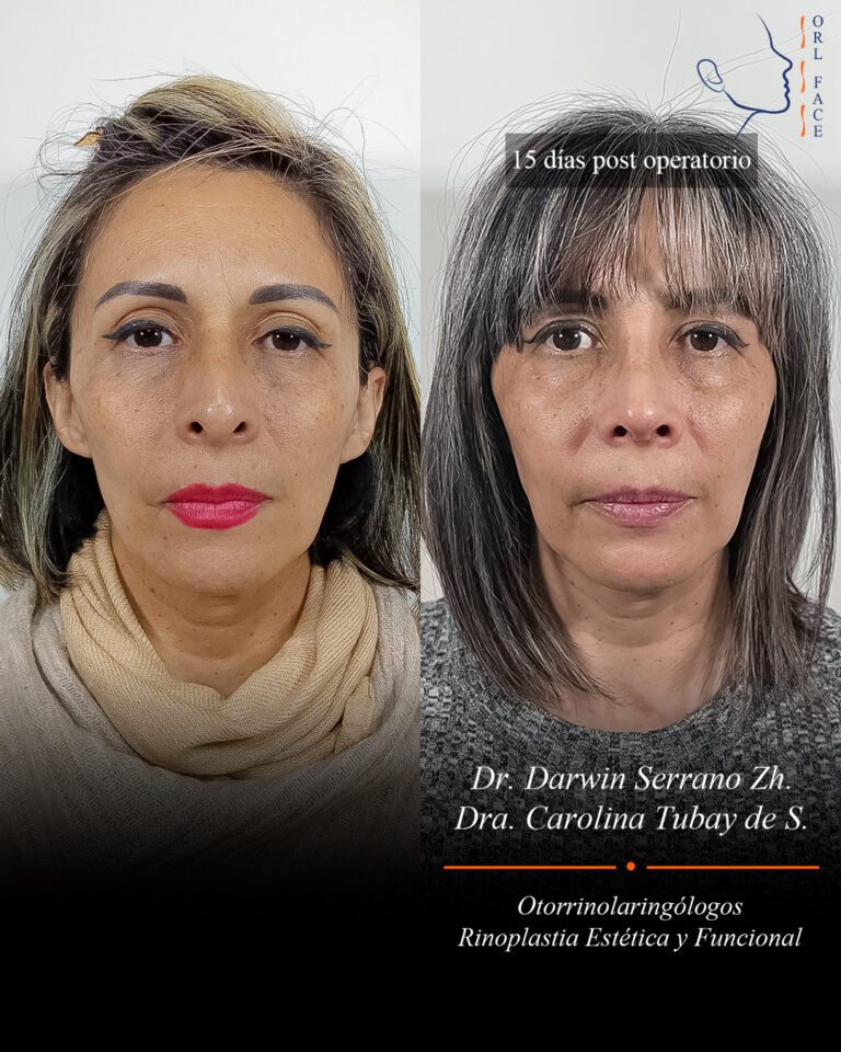 Dr. Darwin Serrano Zh. Dra. Carolina Tubay. Otorrinolaringologo, Otorrino. Salinas. Cirugia estetica nasal.