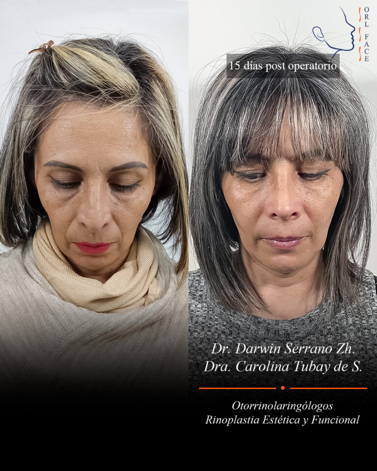 Dr. Darwin Serrano Zh. Dra. Carolina Tubay. Otorrinolaringologo, Otorrino. Salinas. Cirugia estetica nasal.