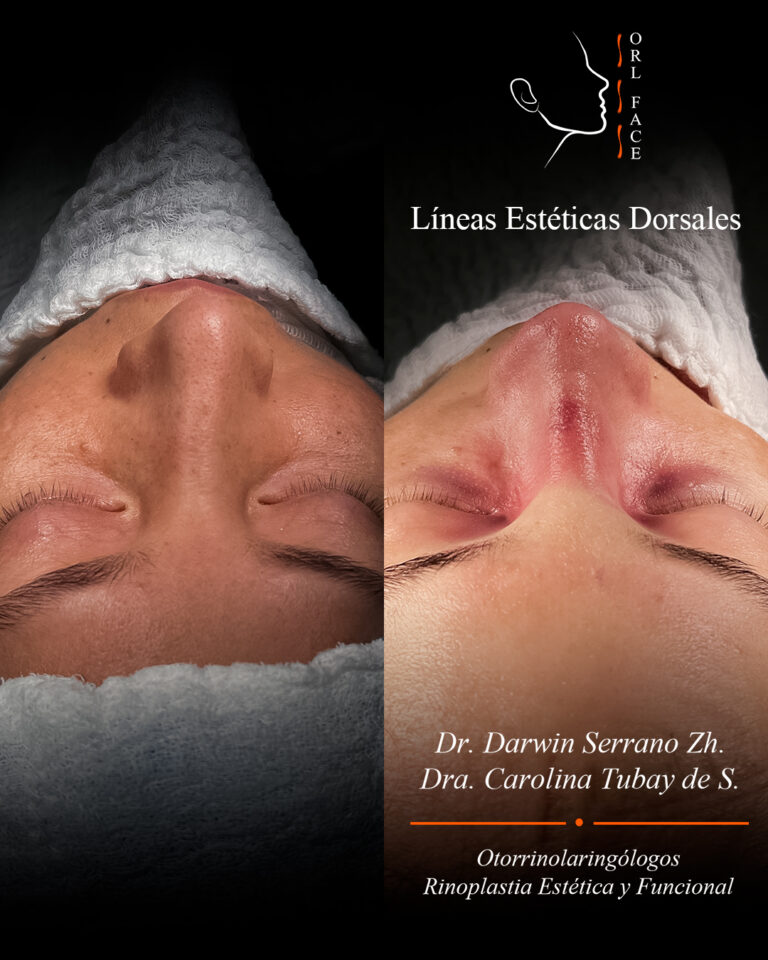 Dr. Darwin Serrano Zh. Dra. Carolina Tubay. Otorrinolaringologo, Otorrino. Salinas. Cirugia estetica nasal.