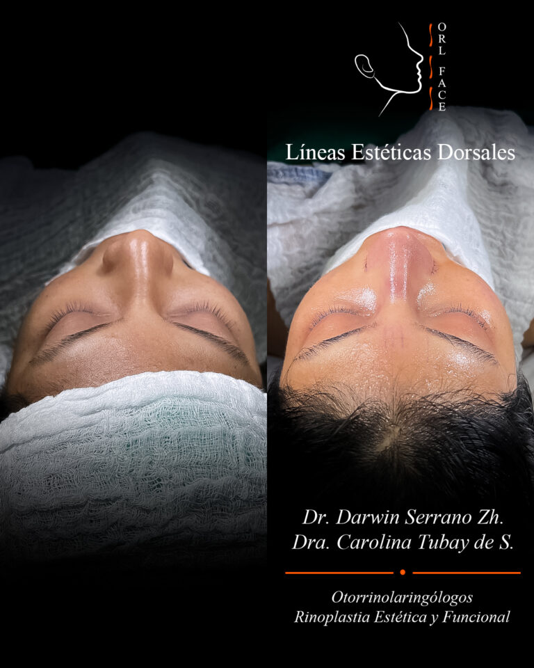 Dr. Darwin Serrano Zh. Dra. Carolina Tubay. Otorrinolaringologo, Otorrino. Salinas. Cirugia estetica nasal.