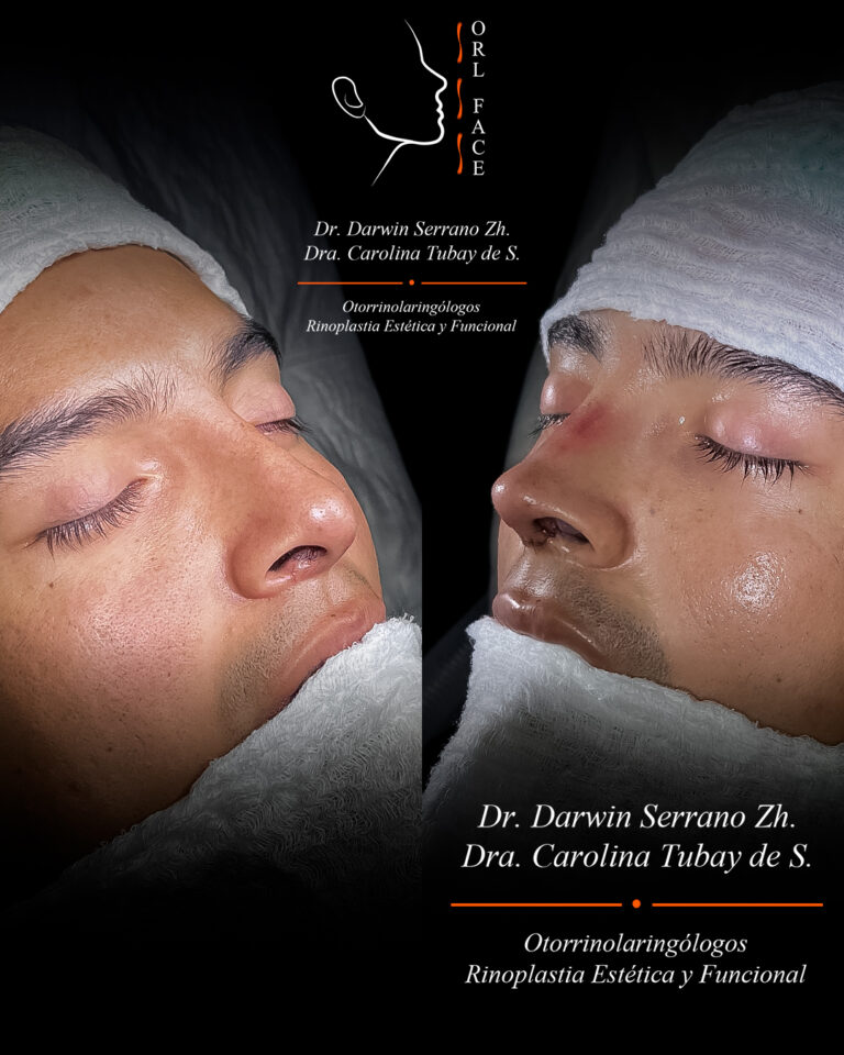 Dr. Darwin Serrano Zh. Dra. Carolina Tubay. Otorrinolaringologo, Otorrino. Salinas. Cirugia estetica nasal.