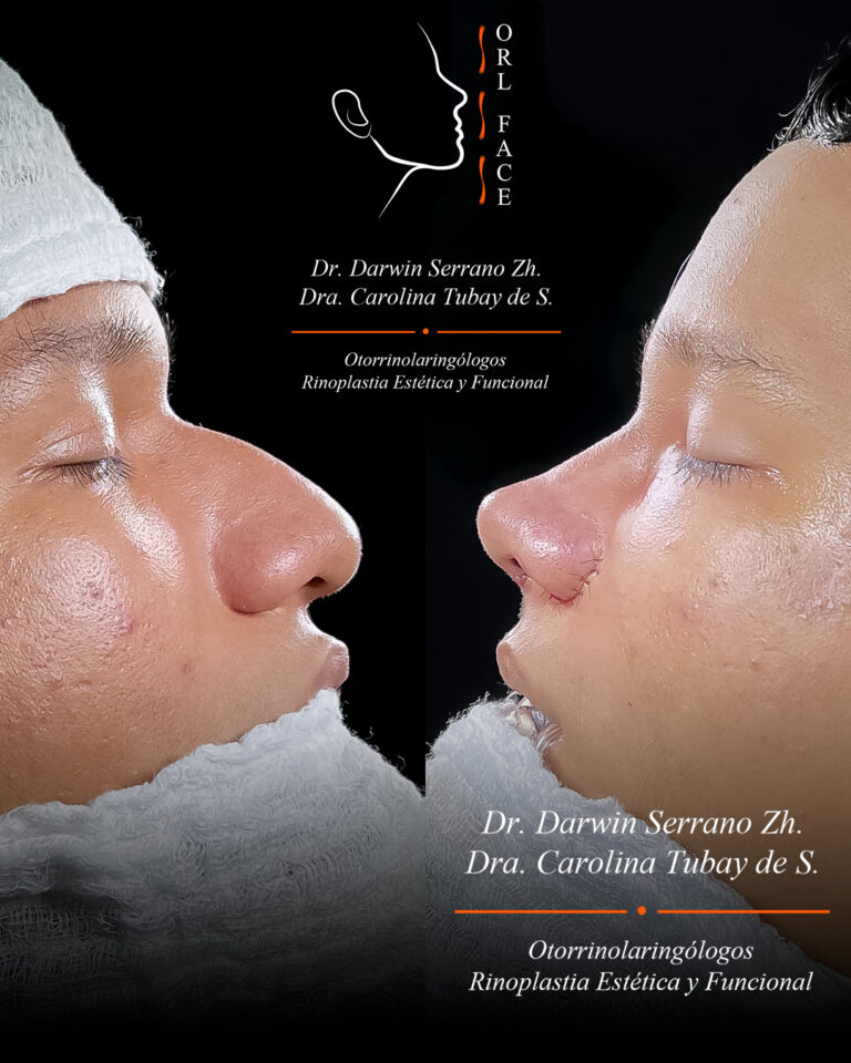 Dr. Darwin Serrano Zh. Dra. Carolina Tubay. Otorrinolaringologo, Otorrino. Salinas. Cirugia estetica nasal.