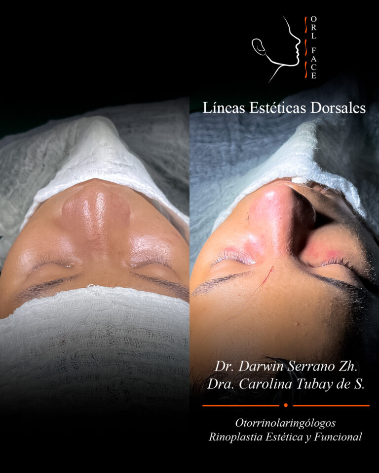 Dr. Darwin Serrano Zh. Dra. Carolina Tubay. Otorrinolaringologo, Otorrino. Salinas. Cirugia estetica nasal.