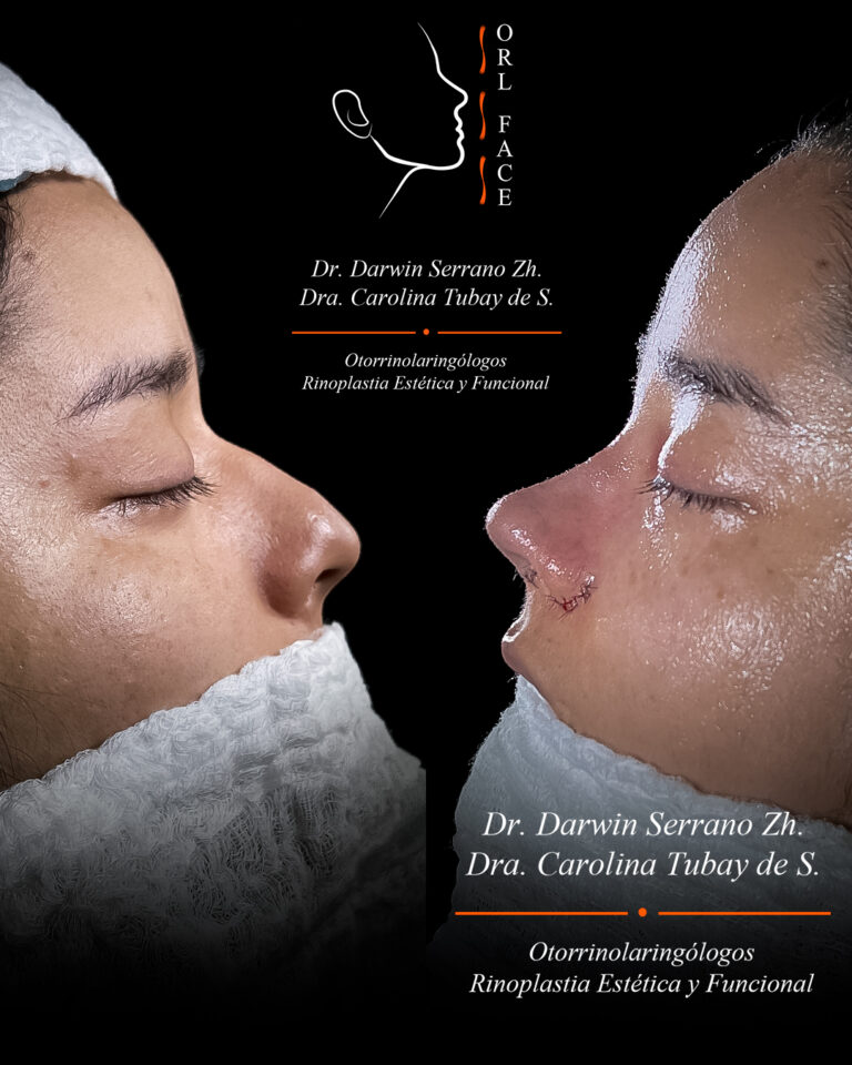 Dr. Darwin Serrano Zh. Dra. Carolina Tubay. Otorrinolaringologo, Otorrino. Salinas. Cirugia estetica nasal.
