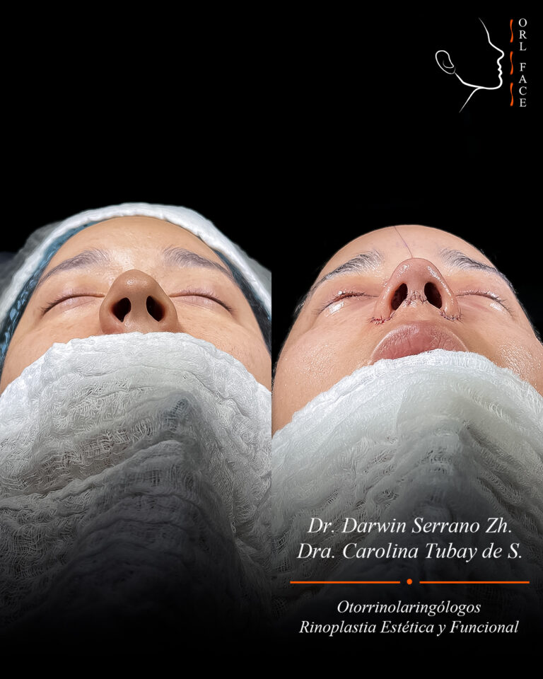 Dr. Darwin Serrano Zh. Dra. Carolina Tubay. Otorrinolaringologo, Otorrino. Salinas. Cirugia estetica nasal.