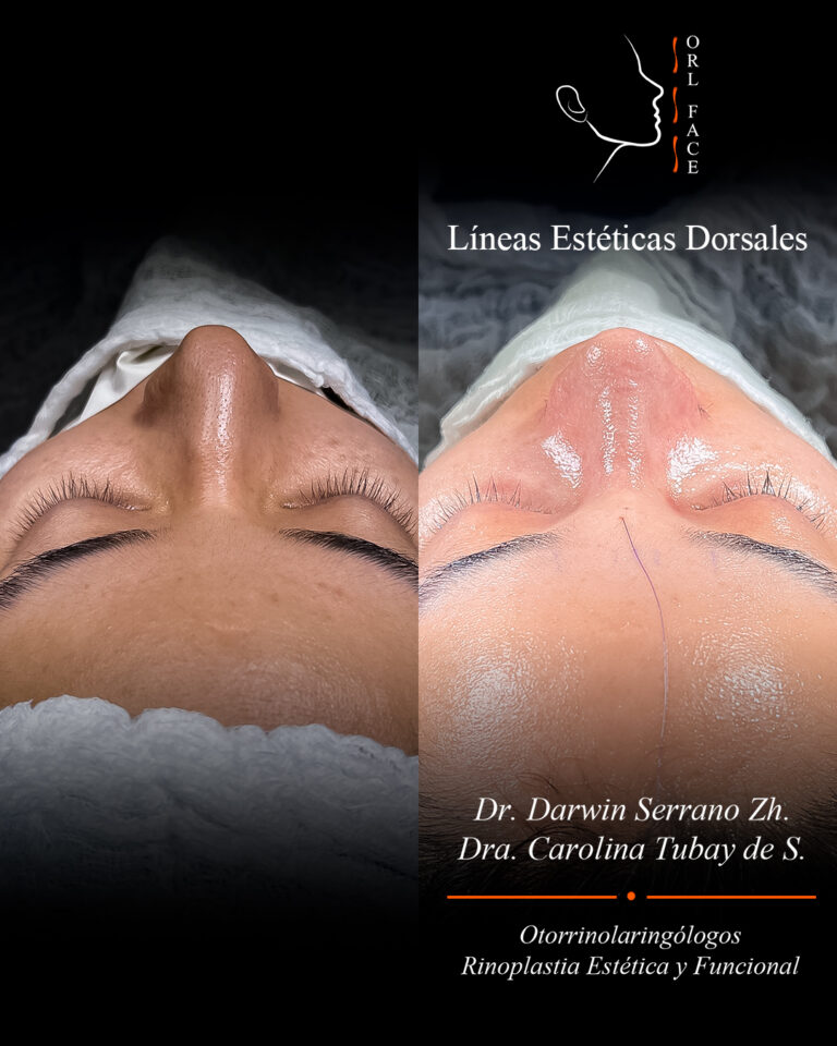 Dr. Darwin Serrano Zh. Dra. Carolina Tubay. Otorrinolaringologo, Otorrino. Salinas. Cirugia estetica nasal.