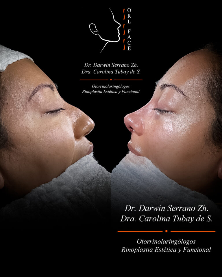 Dr. Darwin Serrano Zh. Dra. Carolina Tubay. Otorrinolaringologo, Otorrino. Salinas. Cirugia estetica nasal.