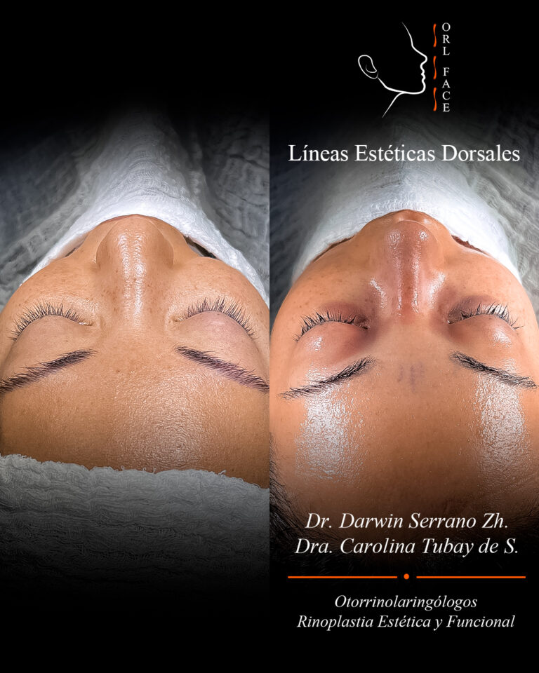 Dr. Darwin Serrano Zh. Dra. Carolina Tubay. Otorrinolaringologo, Otorrino. Salinas. Cirugia estetica nasal.