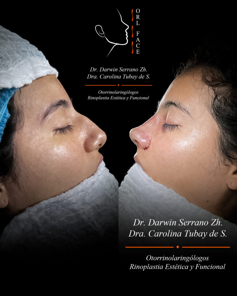 Dr. Darwin Serrano Zh. Dra. Carolina Tubay. Otorrinolaringologo, Otorrino. Salinas. Cirugia estetica nasal.