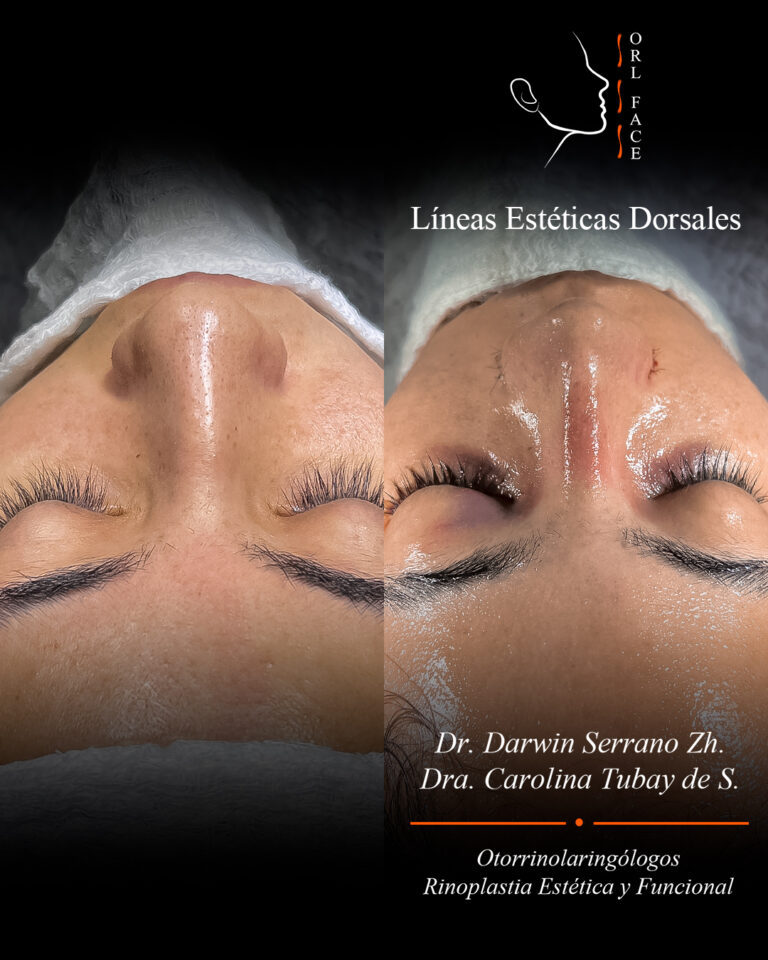 Dr. Darwin Serrano Zh. Dra. Carolina Tubay. Otorrinolaringologo, Otorrino. Salinas. Cirugia estetica nasal.