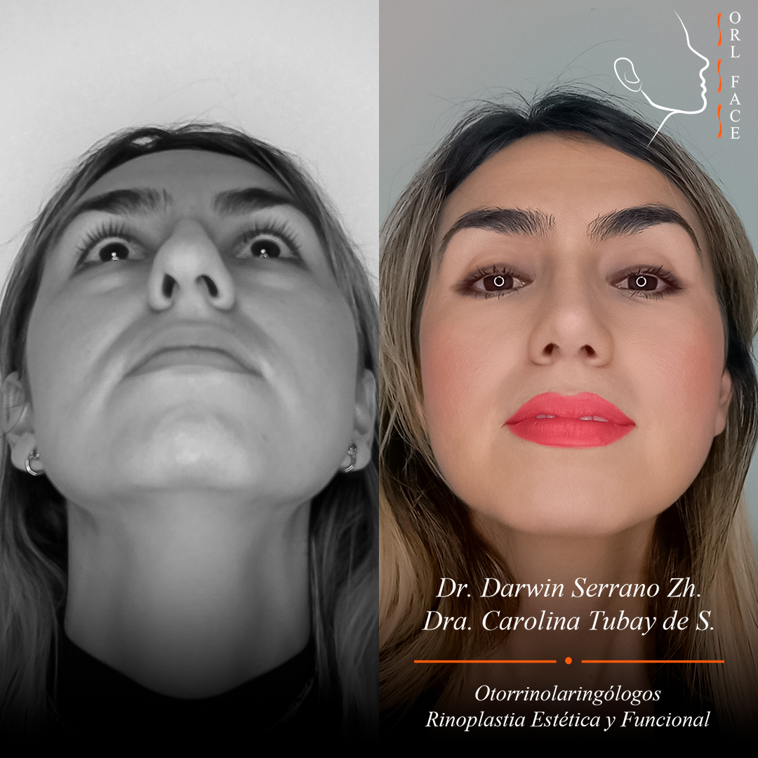 Dr. Darwin Serrano Zh. Dra. Carolina Tubay de S. Otorrinolagingologo, Otorrino. orlface. Manta. Salinas. Rinoplastia.