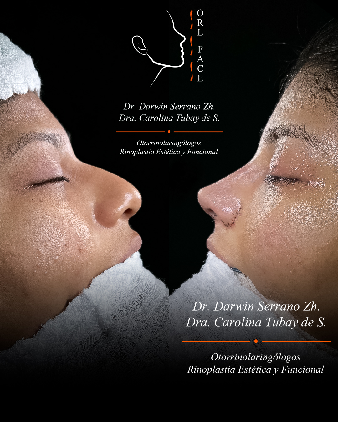 Dr. Darwin Serrano Zh. Dra. Carolina Tubay de S. Otorrinolagingologo, Otorrino. orlface. Manta. Salinas. Rinoplastia.