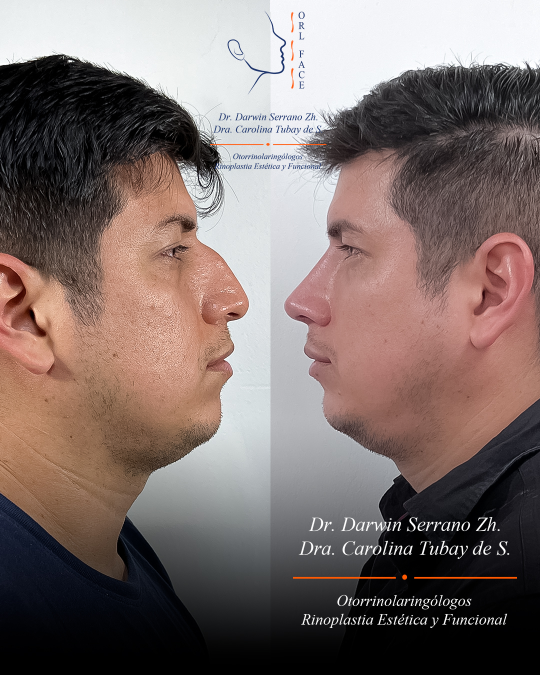 Dr. Darwin Serrano Zh. Dra. Carolina Tubay de S. Otorrinolagingologo, Otorrino. orlface. Manta. Salinas. Rinoplastia.