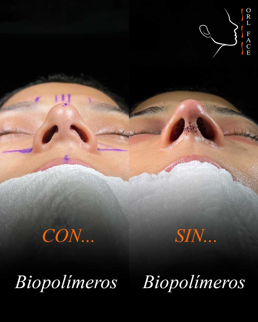 Dr. Darwin Serrano Zh. Dra. Carolina Tubay de S. Otorrinolagingologo, Otorrino. orlface. Manta. Salinas. Rinoplastia.